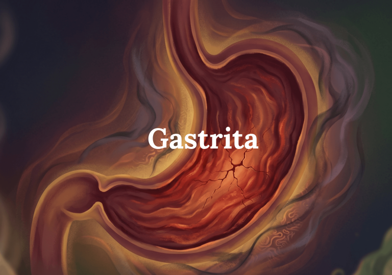 Ilustrație GAPS reprezentând un stomac inflamat și arsura digestivă.