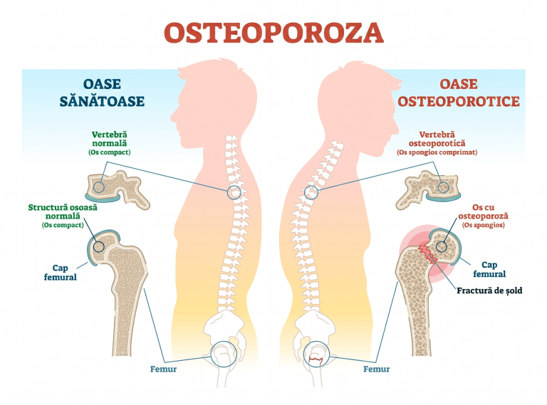 Infografic comparativ între oase sănătoase și oase cu osteoporoză, arătând structura vertebrelor și a șoldului.